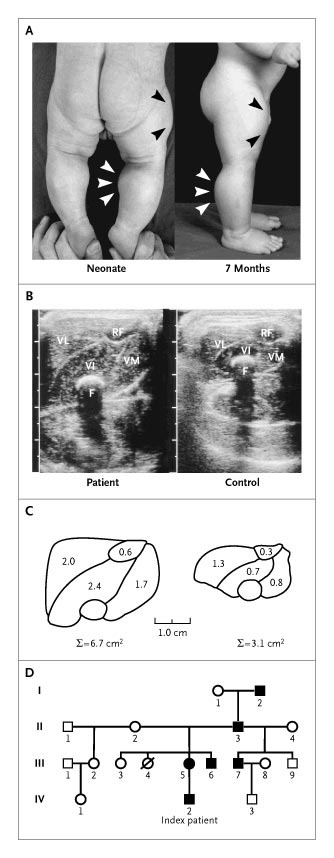 Superbaby myostatin