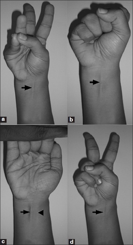 a-Schaeffers-test-opposition-of-thumb-to-little-finger-with-flexion-at-wrist-Arrow